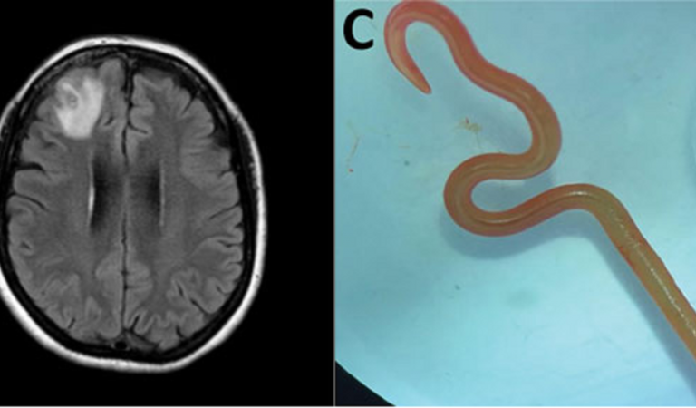 An 8 cm Live Worm Was Removed From a Woman’s Brain: So How Was This Possible?